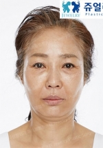 Jewelry Plastic Surgery,Reviews,Images, Promotions — Korea cost, reviews & before-after | MISOODA