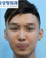Jewelry Plastic Surgery,Reviews,Images, Promotions — Korea cost, reviews & before-after | MISOODA