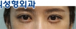 Jewelry Plastic Surgery,Reviews,Images, Promotions — Korea cost, reviews & before-after | MISOODA