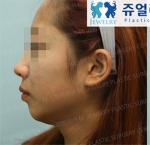 Jewelry Plastic Surgery,Reviews,Images, Promotions — Korea cost, reviews & before-after | MISOODA
