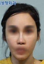 Jewelry Plastic Surgery,Reviews,Images, Promotions — Korea cost, reviews & before-after | MISOODA