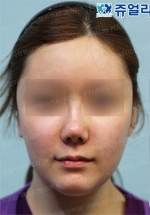 Jewelry Plastic Surgery,Reviews,Images, Promotions — Korea cost, reviews & before-after | MISOODA