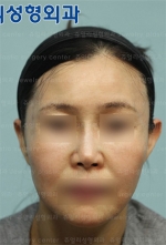 Jewelry Plastic Surgery,Reviews,Images, Promotions — Korea cost, reviews & before-after | MISOODA