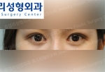 Jewelry Plastic Surgery,Reviews,Images, Promotions — Korea cost, reviews & before-after | MISOODA