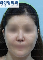 Jewelry Plastic Surgery,Reviews,Images, Promotions — Korea cost, reviews & before-after | MISOODA