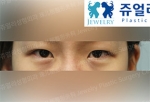 Jewelry Plastic Surgery,Reviews,Images, Promotions — Korea cost, reviews & before-after | MISOODA