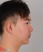 facial contouring