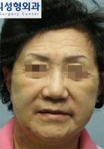 Jewelry Plastic Surgery,Reviews,Images, Promotions — Korea cost, reviews & before-after | MISOODA