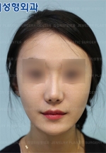 Jewelry Plastic Surgery,Reviews,Images, Promotions — Korea cost, reviews & before-after | MISOODA