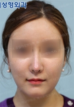 Jewelry Plastic Surgery,Reviews,Images, Promotions — Korea cost, reviews & before-after | MISOODA