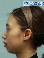 Jewelry Plastic Surgery,Reviews,Images, Promotions — Korea cost, reviews & before-after | MISOODA