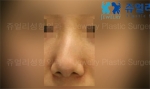 Jewelry Plastic Surgery,Reviews,Images, Promotions — Korea cost, reviews & before-after | MISOODA
