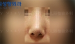 Jewelry Plastic Surgery,Reviews,Images, Promotions — Korea cost, reviews & before-after | MISOODA
