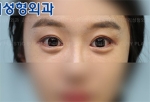 Jewelry Plastic Surgery,Reviews,Images, Promotions — Korea cost, reviews & before-after | MISOODA