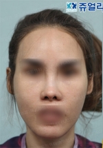 Jewelry Plastic Surgery,Reviews,Images, Promotions — Korea cost, reviews & before-after | MISOODA