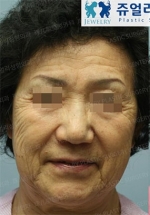 Jewelry Plastic Surgery,Reviews,Images, Promotions — Korea cost, reviews & before-after | MISOODA