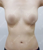 liposuction