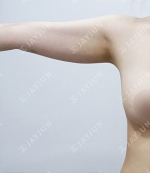 liposuction