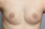 breast