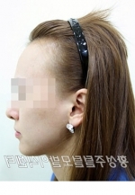 hairline