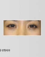eye surgery