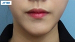 MARBLE Plastic Surgery,Reviews,Images, Promotions — Korea cost, reviews & before-after | MISOODA