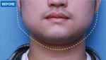 MARBLE Plastic Surgery,Reviews,Images, Promotions — Korea cost, reviews & before-after | MISOODA