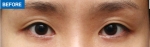 MARBLE Plastic Surgery,Reviews,Images, Promotions — Korea cost, reviews & before-after | MISOODA
