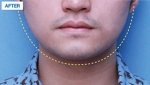 MARBLE Plastic Surgery,Reviews,Images, Promotions — Korea cost, reviews & before-after | MISOODA