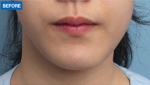 MARBLE Plastic Surgery,Reviews,Images, Promotions — Korea cost, reviews & before-after | MISOODA