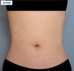 MARBLE Plastic Surgery,Reviews,Images, Promotions — Korea cost, reviews & before-after | MISOODA