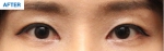 MARBLE Plastic Surgery,Reviews,Images, Promotions — Korea cost, reviews & before-after | MISOODA