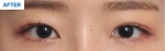 MARBLE Plastic Surgery,Reviews,Images, Promotions — Korea cost, reviews & before-after | MISOODA