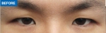 MARBLE Plastic Surgery,Reviews,Images, Promotions — Korea cost, reviews & before-after | MISOODA