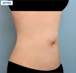 MARBLE Plastic Surgery,Reviews,Images, Promotions — Korea cost, reviews & before-after | MISOODA