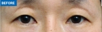 MARBLE Plastic Surgery,Reviews,Images, Promotions — Korea cost, reviews & before-after | MISOODA