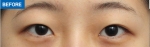 MARBLE Plastic Surgery,Reviews,Images, Promotions — Korea cost, reviews & before-after | MISOODA