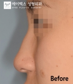 Rhinoplasty