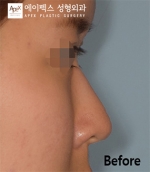 Rhinoplasty