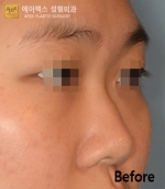 Rhinoplasty