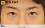 eye surgery