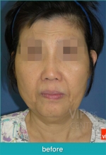 face lift