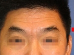 face lift