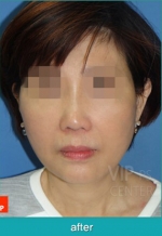face lift