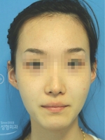 MISOU Plastic Surgery, Reviews,Images, Promotions — Korea cost, reviews & before-after | MISOODA