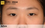 eye surgery