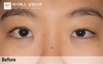 eye surgery