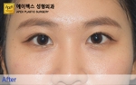 eye surgery