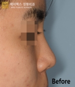 Rhinoplasty