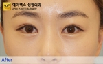 eye surgery